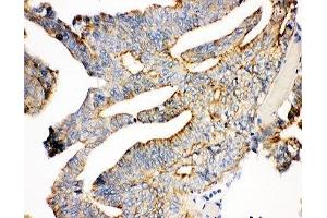 IHC-P: Plakoglobin antibody testing of human intestine cancer tissue (JUP antibody  (AA 556-745))