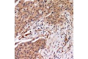Immunohistochemical analysis of MYPT1 (pT696) staining in human breast cancer formalin fixed paraffin embedded tissue section. (PPP1R12A antibody  (pSer696))