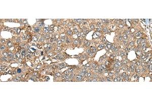 Immunohistochemistry of paraffin-embedded Human liver cancer tissue using BRD9 Polyclonal Antibody at dilution of 1:80(x200) (BRD9 antibody)