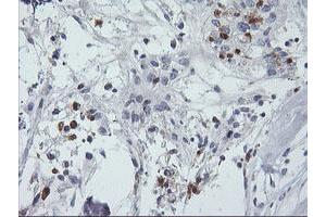 Immunohistochemical staining of paraffin-embedded Adenocarcinoma of Human breast tissue using anti-SDS mouse monoclonal antibody. (serine Dehydratase antibody)