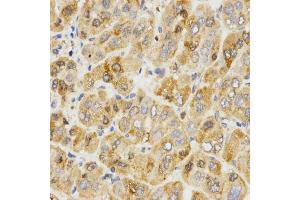 Immunohistochemistry of paraffin-embedded human liver cancer using TPM2 antibody (ABIN5971583) at dilution of 1/200 (40x lens). (TPM2 antibody)