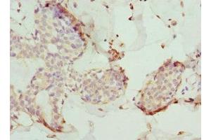Immunohistochemistry of paraffin-embedded human breast cancer using ABIN7173557 at dilution of 1:100 (Tropomodulin 4 antibody  (AA 1-345))