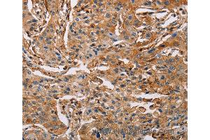 Immunohistochemistry of Human lung cancer using ACTA1 Polyclonal Antibody at dilution of 1:65 (Actin antibody)