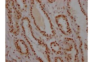 IHC image of ABIN7127535 diluted at 1:100 and staining in paraffin-embedded human prostate cancer performed on a Leica BondTM system. (Recombinant USP7 antibody)
