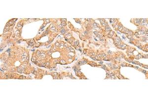 Immunohistochemistry of paraffin-embedded Human thyroid cancer tissue using DEF8 Polyclonal Antibody at dilution of 1:25(x200) (DEF8 antibody)