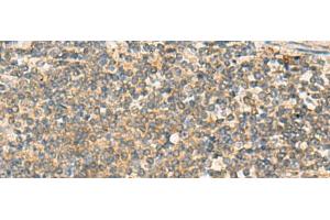 Immunohistochemistry of paraffin-embedded Human colorectal cancer tissue using PAFAH1B3 Polyclonal Antibody at dilution of 1:70(x200) (PAFAH1B3 antibody)