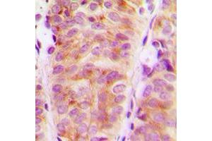 Immunohistochemical analysis of ARHGEF10 staining in human breast cancer formalin fixed paraffin embedded tissue section. (ARHGEF10 antibody  (Center))