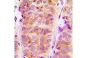 Immunohistochemical analysis of ARHGEF10 staining in human breast cancer formalin fixed paraffin embedded tissue section.