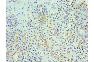 Immunohistochemistry of paraffin-embedded human breast cancer using ABIN7155322 at dilution of 1:100 (HDAC6 antibody  (AA 160-470))