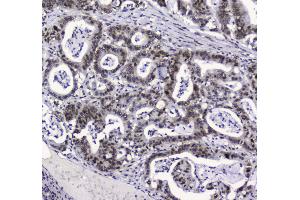 IHC analysis of APE1 using anti-APE1 antibody . (APEX1 antibody  (AA 2-318))