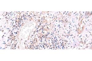 Immunohistochemistry of paraffin-embedded Human cervical cancer tissue using MRPS24 Polyclonal Antibody at dilution of 1:90(x200)