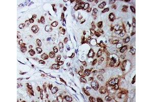 IHC-P: Lamin B1 antibody testing of human breast cancer tissue (Lamin B1 antibody  (AA 570-586))