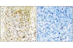 Immunohistochemistry analysis of paraffin-embedded human breast carcinoma tissue, using MLK3 (Ab-674) Antibody. (MAP3K11 antibody  (AA 640-689))