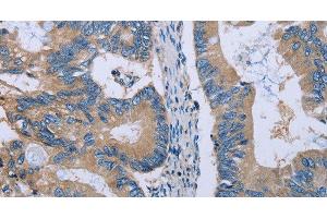 Immunohistochemistry of paraffin-embedded Human colon cancer using HYAL3 Polyclonal Antibody at dilution of 1:40