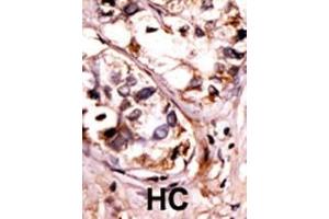 Formalin-fixed and paraffin-embedded human cancer tissue reacted with the primary antibody, which was peroxidase-conjugated to the secondary antibody, followed by AEC staining. (SYK antibody  (pTyr525, pTyr526))