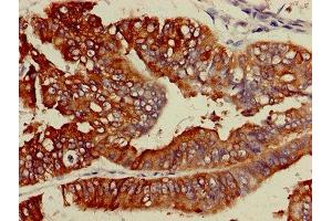 IHC image of ABIN7158511 diluted at 1:600 and staining in paraffin-embedded human endometrial cancer performed on a Leica BondTM system. (ACSL5 antibody  (AA 33-683))