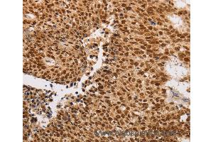 Immunohistochemistry of Human lung cancer using THOC7 Polyclonal Antibody at dilution of 1:30