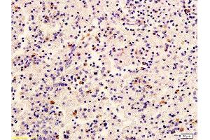 Formalin-fixed and paraffin embedded human cervical carcinoma labeled with Anti-HER2/NEU/ErbB2 Polyclonal Antibody, Unconjugated  at 1:400 followed by conjugation to the secondary antibody and DAB staining (ErbB2/Her2 antibody  (AA 1210-1255))