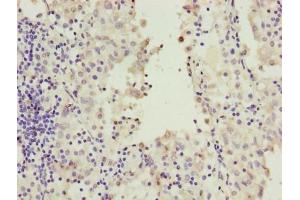 Immunohistochemistry of paraffin-embedded human lung cancer using ABIN7167244 at dilution of 1:100 (RAB2A antibody  (AA 1-234))