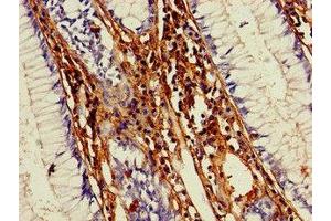 Immunohistochemistry of paraffin-embedded human colon cancer using ABIN7148281 at dilution of 1:100 (MMP13 antibody  (AA 104-471))