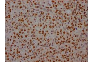 IHC image of ABIN7127805 diluted at 1:100 and staining in paraffin-embedded human glioma cancer performed on a Leica BondTM system. (Recombinant SF3B1 antibody)