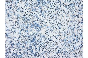 Immunohistochemical staining of paraffin-embedded Adenocarcinoma of breast tissue using anti-NAT8 mouse monoclonal antibody.
