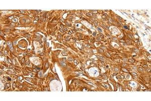 Immunohistochemistry of paraffin-embedded Human esophagus cancer using SFTPA1 Polyclonal Antibody at dilution of 1:30 (Surfactant Protein A1 antibody)