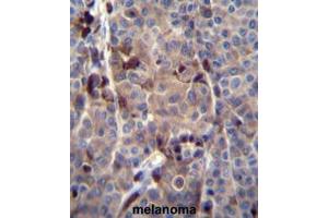 PRAMEF8 Antibody (C-term) immunohistochemistry analysis in formalin fixed and paraffin embedded human melanoma tissue followed by peroxidase conjugation of the secondary antibody and DAB staining. (PRAMEF8 antibody  (C-Term))