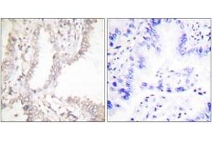 Immunohistochemistry analysis of paraffin-embedded human lung carcinoma tissue, using Prostate Apoptosis Response protein-4 Antibody. (PAWR antibody  (AA 291-340))