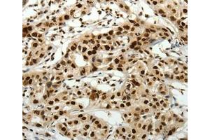 Immunohistochemical analysis of paraffin-embedded Human lung cancer tissue using at dilution 1/40. (SCN11A antibody  (Internal Region))