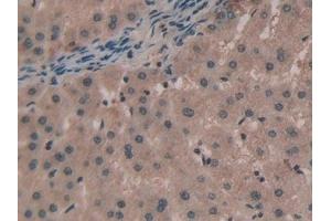 Detection of TNPO1 in Human Liver cancer Tissue using Polyclonal Antibody to Transportin 1 (TNPO1) (Transportin 1 antibody  (AA 626-836))