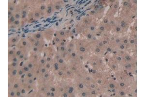 Detection of TNPO1 in Human Liver cancer Tissue using Polyclonal Antibody to Transportin 1 (TNPO1) (Transportin 1 antibody  (AA 626-836))