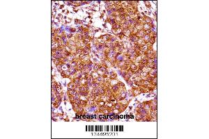 IRX3 Antibody immunohistochemistry analysis in formalin fixed and paraffin embedded human breast carcinoma followed by peroxidase conjugation of the secondary antibody and DAB staining. (IRX3 antibody  (N-Term))