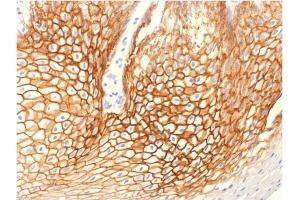 Formalin-fixed, paraffin-embedded human Cervical Carcinoma stained with Catenin, gamma Mouse Monoclonal Antibody (CTNG/1664) (JUP antibody)