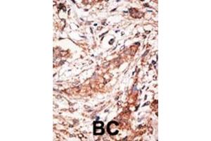 Formalin-fixed and paraffin-embedded human cancer tissue reacted with the primary antibody, which was peroxidase-conjugated to the secondary antibody, followed by DAB staining. (DOK4 antibody  (C-Term))