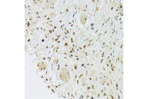 Immunohistochemistry of paraffin-embedded human gastric cancer using EFTUD2 Antibody. (EFTUD2 antibody  (AA 1-205))