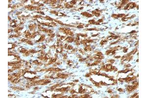 Formalin-fixed, paraffin-embedded human Rhabdomyosarcoma stained with Muscle Specific Actin Mouse Monoclonal Antibody (HHF35). (ACTA1/ACTA2A/ACTG2 antibody)