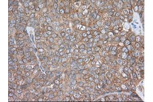 Immunohistochemical staining of paraffin-embedded Adenocarcinoma of Human colon tissue using anti-PDE4A mouse monoclonal antibody. (PDE4A antibody)