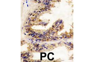 Formalin-fixed and paraffin-embedded human prostate carcinoma reacted with BRAF polyclonal antibody  , which was peroxidase-conjugated to the secondary antibody, followed by DAB staining.