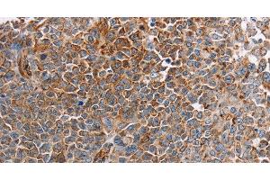 Immunohistochemistry of paraffin-embedded Human ovarian cancer tissue using PLXNA2 Polyclonal Antibody at dilution 1:40