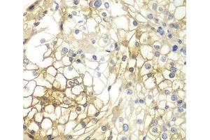 Immunohistochemistry of paraffin-embedded Human kidney cancer using Syndecan-1 Polyclonal Antibody at dilution of 1:200 (40x lens). (Syndecan 1 antibody)