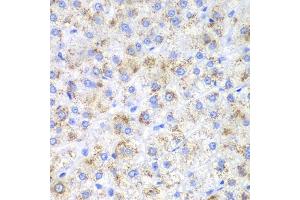 Immunohistochemistry of paraffin-embedded human liver cancer using HAO1 antibody. (HAO1 antibody)