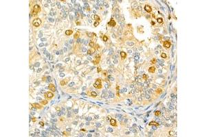 Immunohistochemistry of paraffin embedded human metrocarcinoma using ANXA3 (ABIN7073065) at dilution of 1: 200 (400x lens) (Annexin A3 antibody)