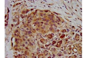 IHC image of ABIN7168260 diluted at 1:400 and staining in paraffin-embedded human pancreatic cancer performed on a Leica BondTM system. (RNF39 antibody  (AA 200-321))
