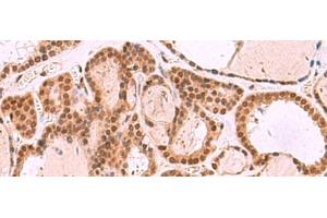 Immunohistochemistry of paraffin-embedded Human thyroid cancer tissue using MCMBP Polyclonal Antibody at dilution of 1:35(x200) (MCMBP antibody)