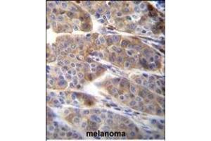 PLA2G2C Antibody (C-term) (ABIN655935 and ABIN2845327) immunohistochemistry analysis in formalin fixed and paraffin embedded human melanoma followed by peroxidase conjugation of the secondary antibody and DAB staining. (PLA2G2C antibody  (C-Term))