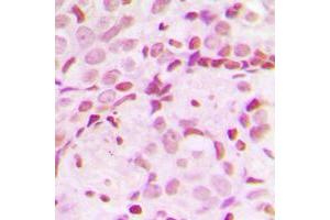 Immunohistochemical analysis of TCOF1 staining in human breast cancer formalin fixed paraffin embedded tissue section. (TCOF1 antibody  (N-Term))