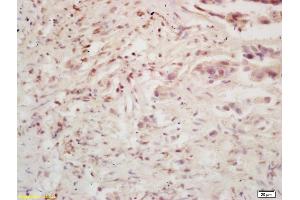Formalin-fixed and paraffin embedded human colon carcinoma labeled with Rabbit Anti BMI1/PCGF4 Polyclonal Antibody, Unconjugated (ABIN682678) at 1:200 followed by conjugation to the secondary antibody and DAB staining (BMI1 antibody  (AA 61-160))