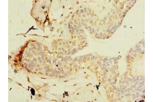 Immunohistochemistry of paraffin-embedded human breast cancer using ABIN7171449 at dilution of 1:100