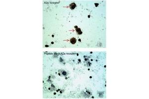 ADORA2A antibody staining of Oral Cell Carcinoma at a dilution of 5 ug/ml (Adenosine A2a Receptor antibody  (C-Term))